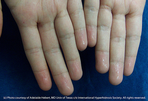 Sweaty Hands - International Hyperhidrosis Society | Site